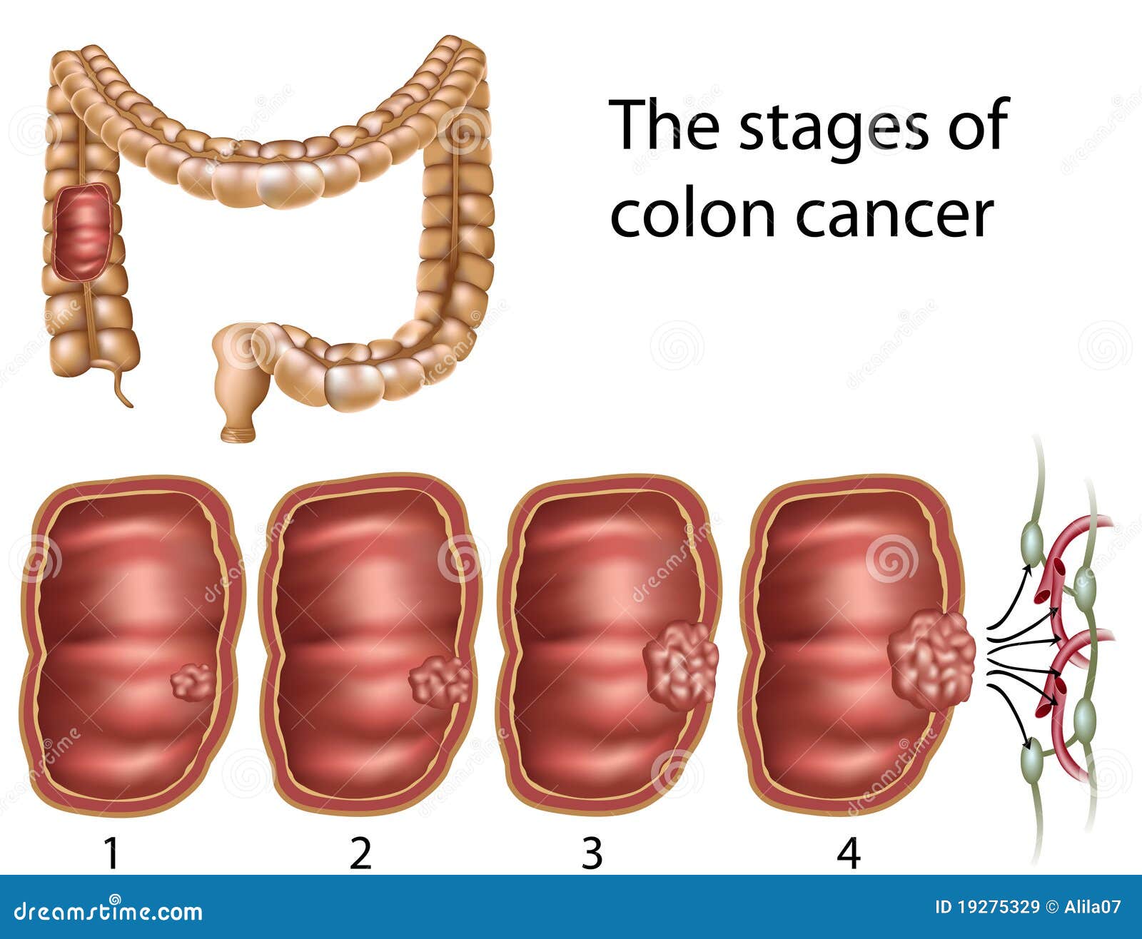cancerul la colon