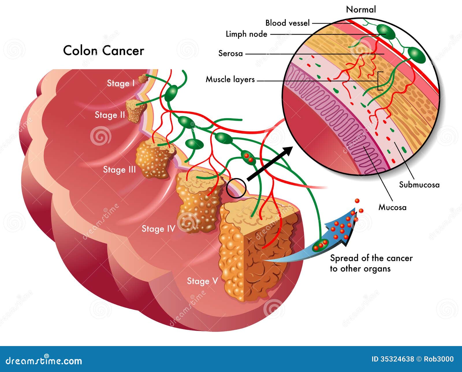 colon cancer