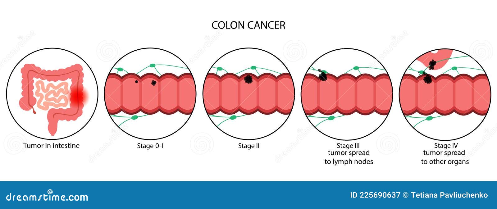 colon cancer stage 0