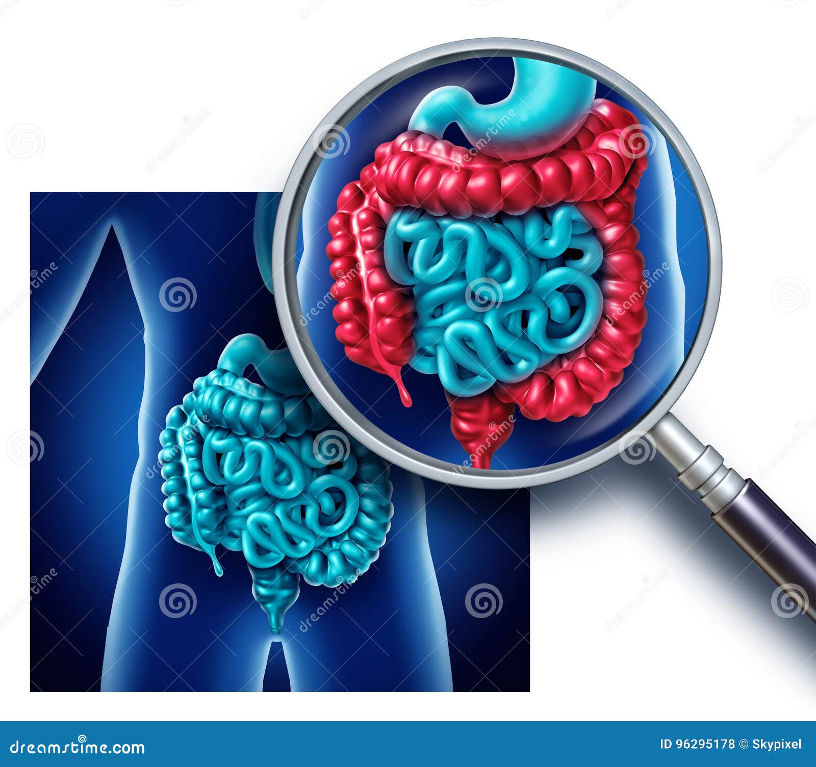 Large Intestine Inflammation