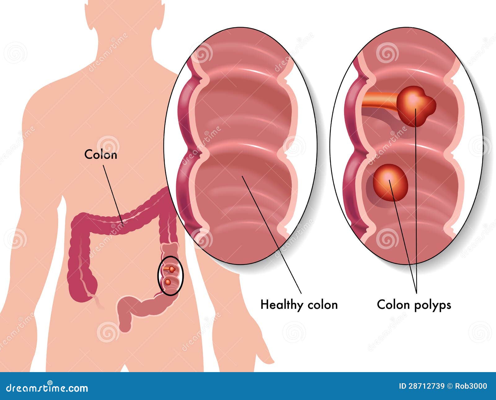 colon polyps