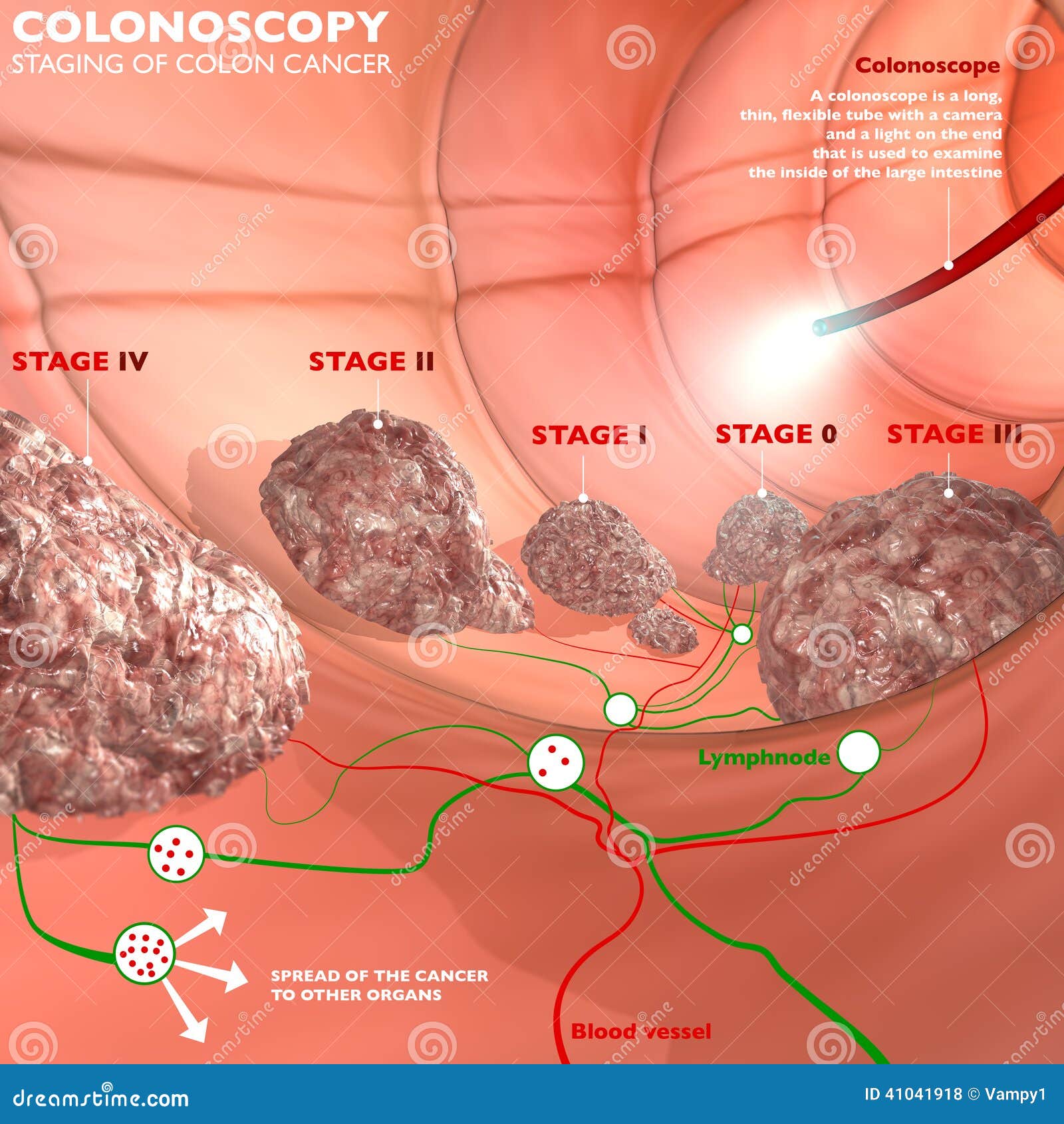 Colonoscopie et sonde illustration stock. Illustration of tumeur 41041918