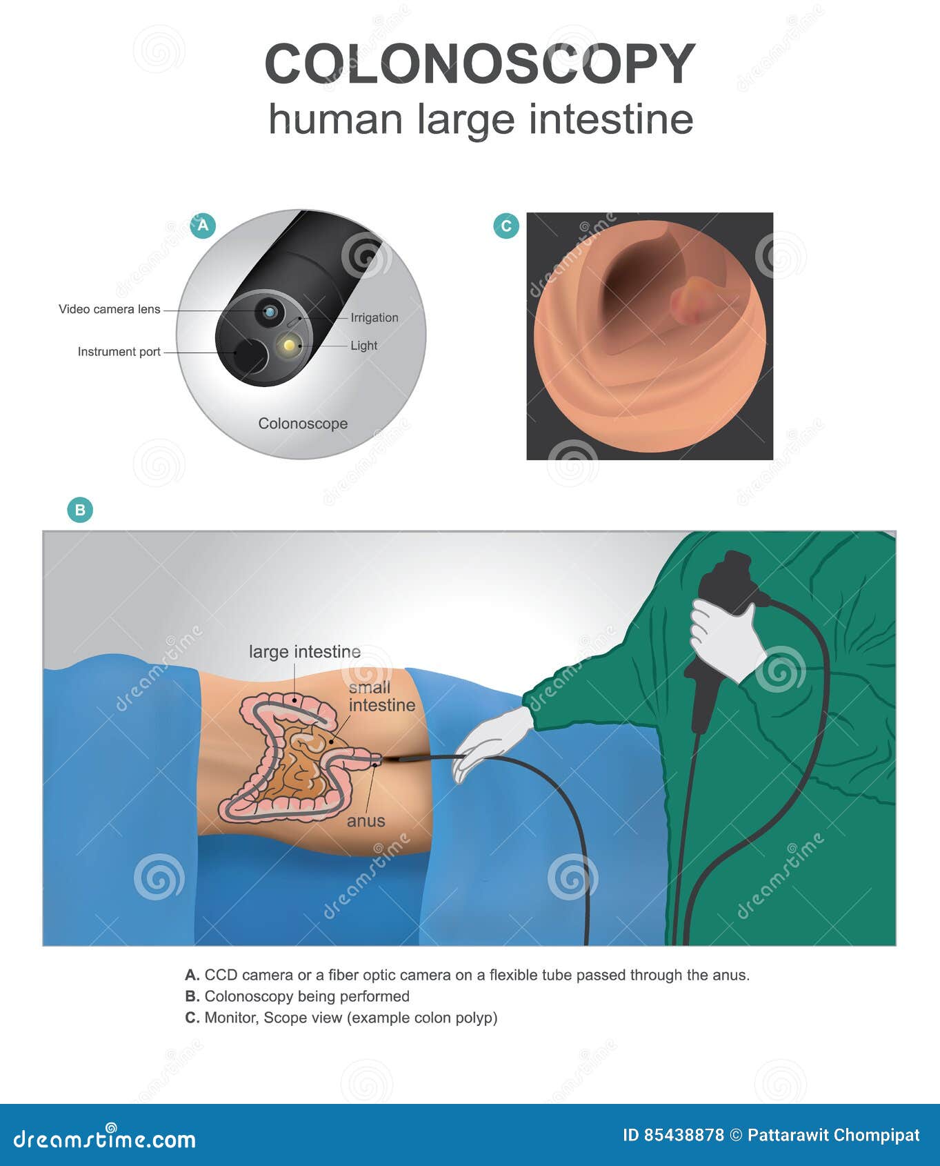 colonoscopy human anatomy illustration stock vector illustration