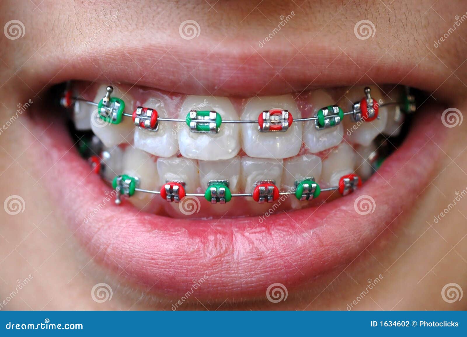 Download Colorful braces stock photo Image of christmas orthodonture