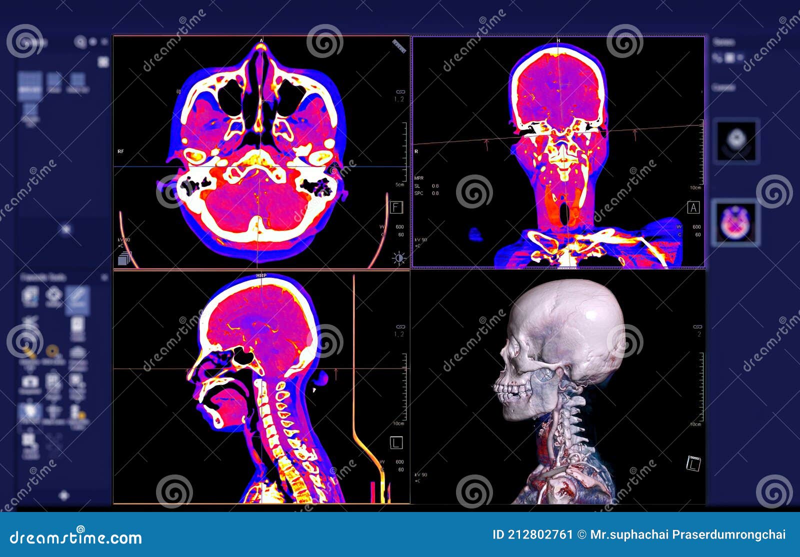 Colorful Of CT Angiography Of The Brain Or CTA Brain Comparison Axial ...