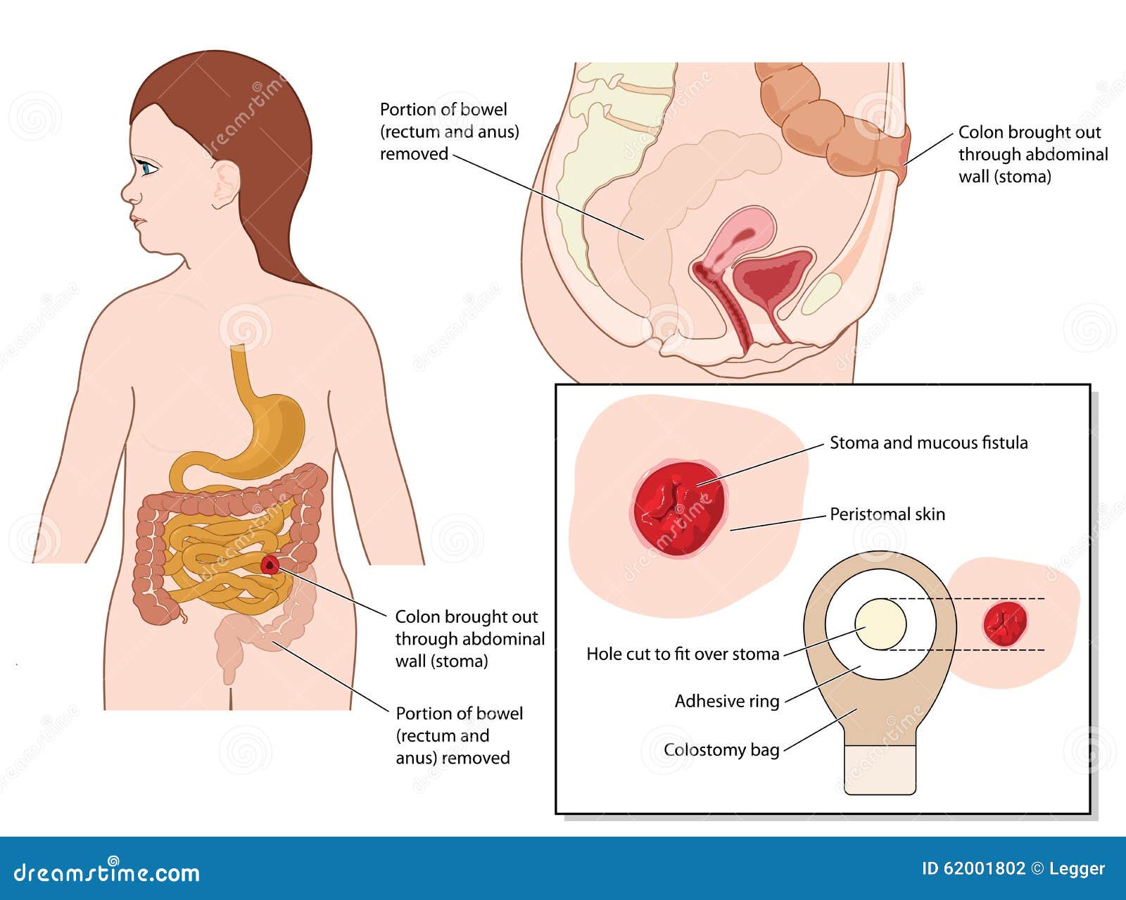 OstomyCure – A Revolution in Stoma Therapy