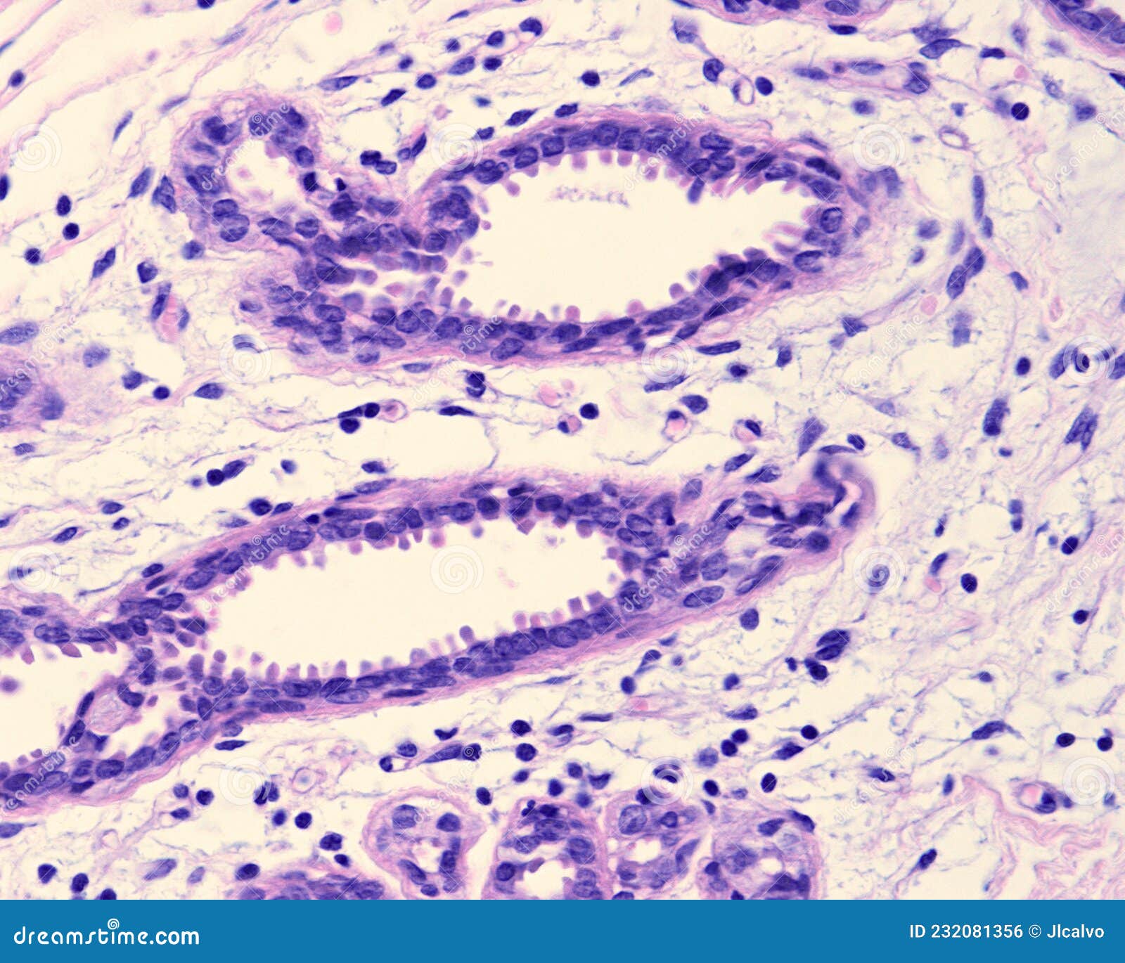 Human breast gland. Adenosis. Columnar cell or blunt duct adenosis. The terminal duct lobular units TDLU show dilated acini lined by tightly packed columnar epithelial cells with prominent apical cytoplasmic snouts