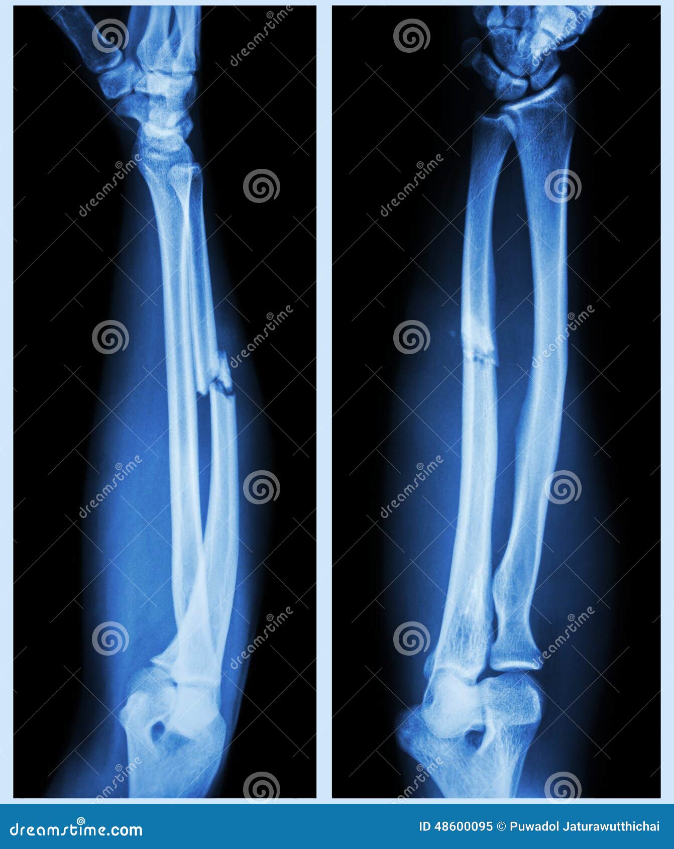 comminuted fracture shaft of ulnar bone