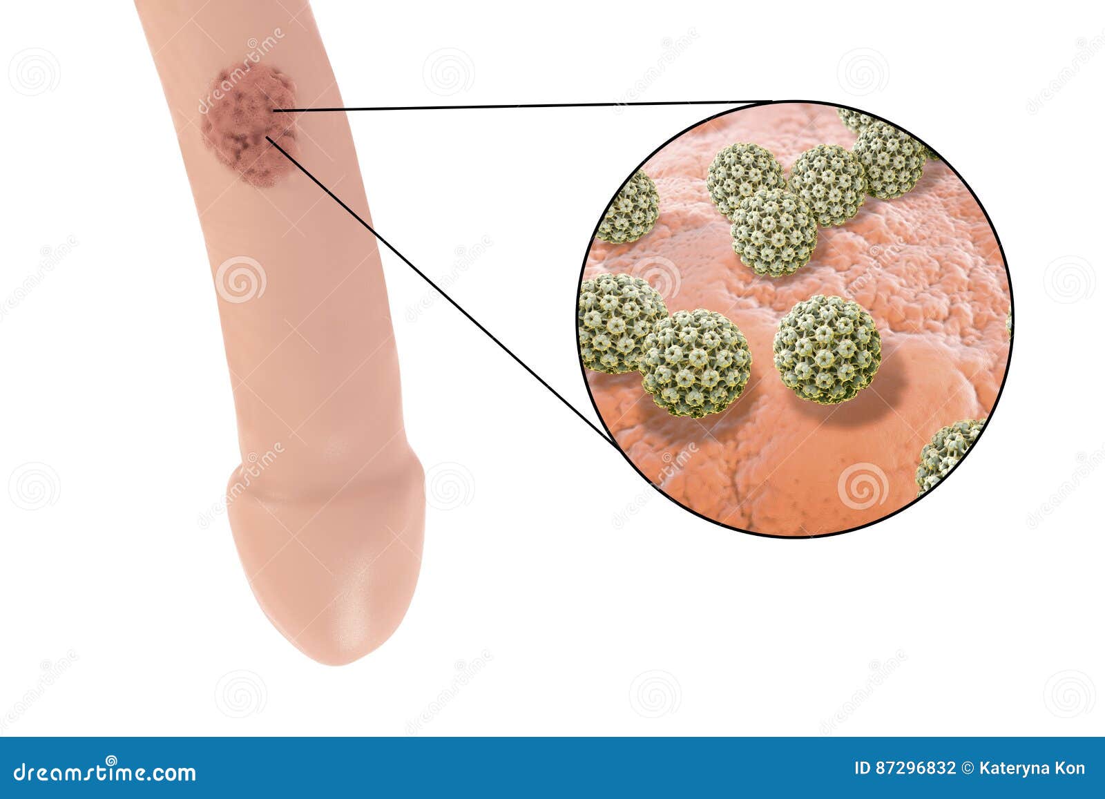 Human papilloma virus in male. Hpv virus treatment