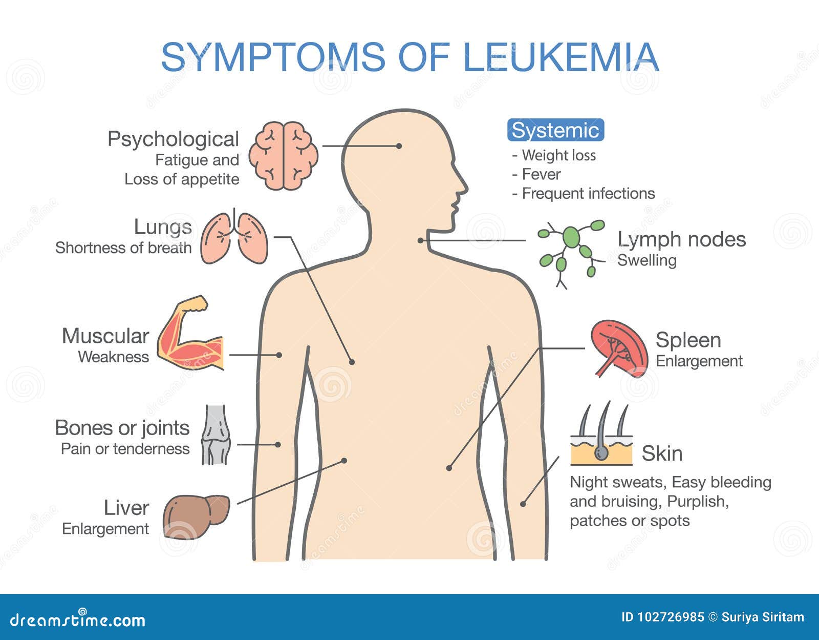 Symptoms Of Leukemia Vector Illustration CartoonDealer 70924356 symptoms-of-leukemia-vector-illustration-cartoondealer-70924356