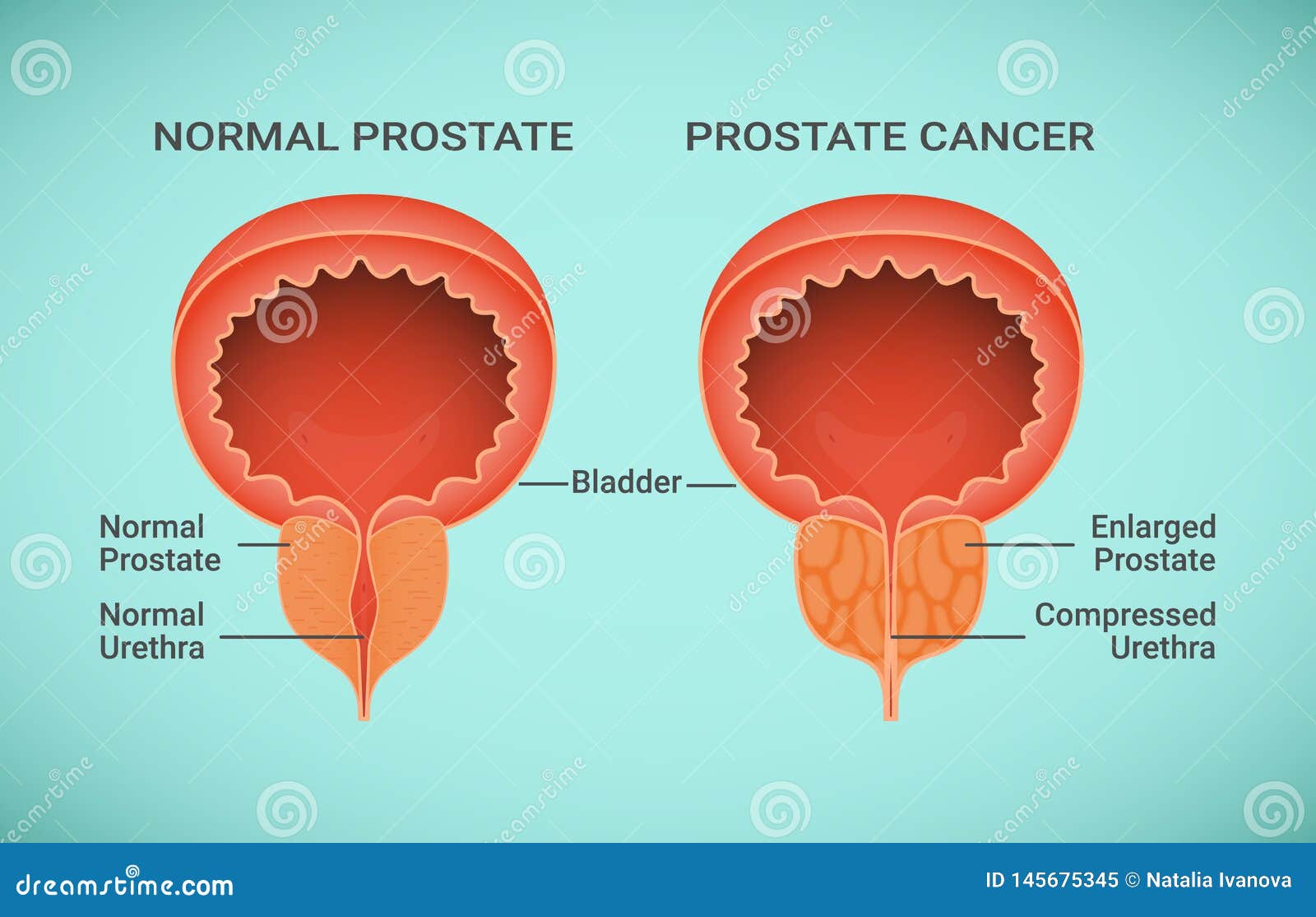 healthy prostate)