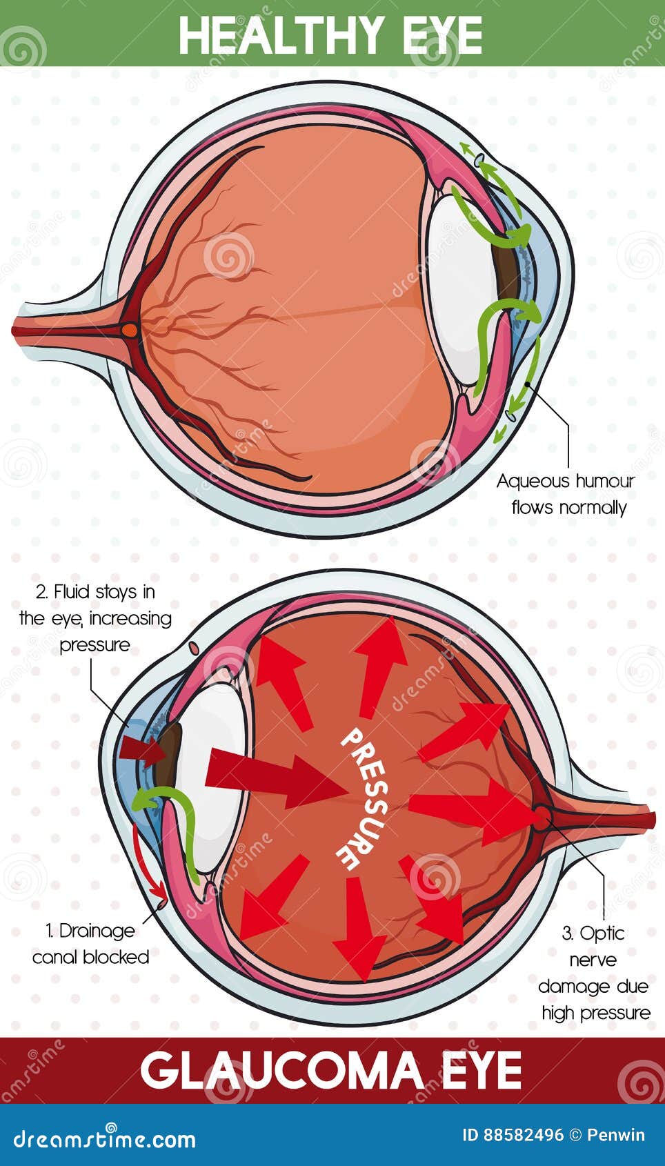 Comparative Information between Healthy Eye and Eye, Vector
