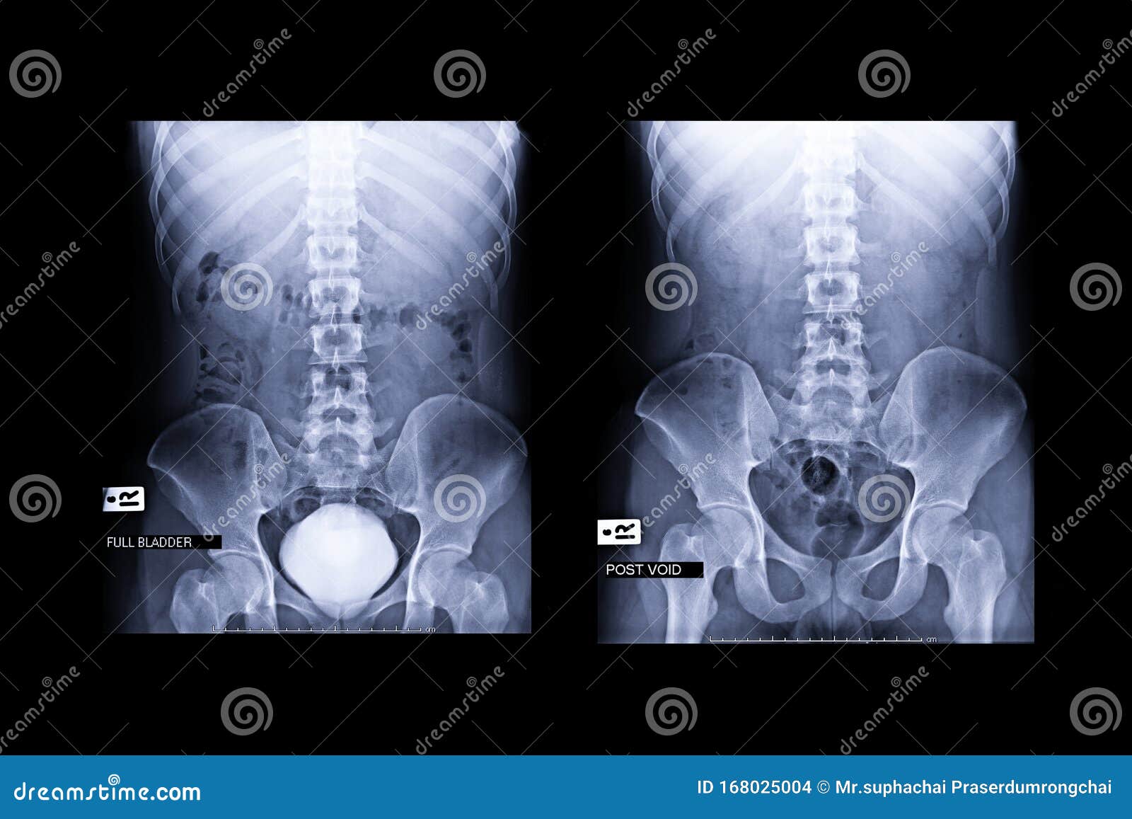 Compare Intravenous Pyelogram or I.V.P is an Xray Exam of Urinary