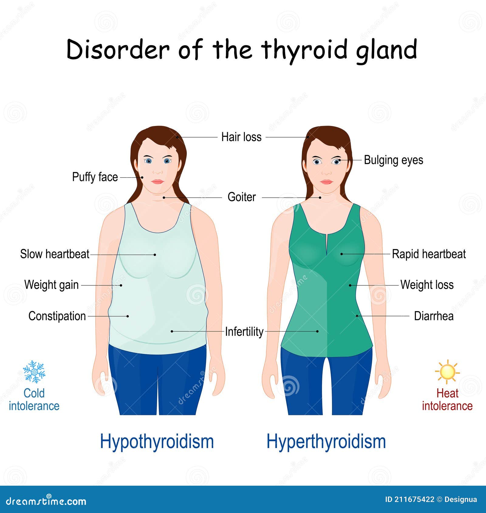 Comparison And Difference Between Hyperthyroidism And Hypothyroidism Stock Vector Illustration Of Hyperthyroid Cancer 211675422
