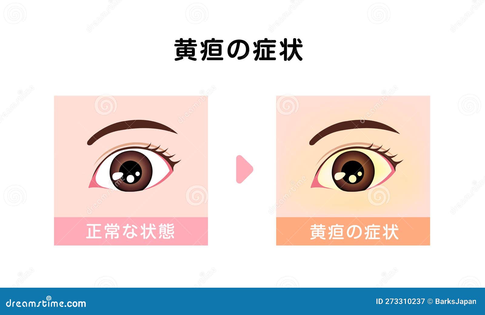 Comparison Illustration of Normal and Jaundiced Eyes Stock Vector