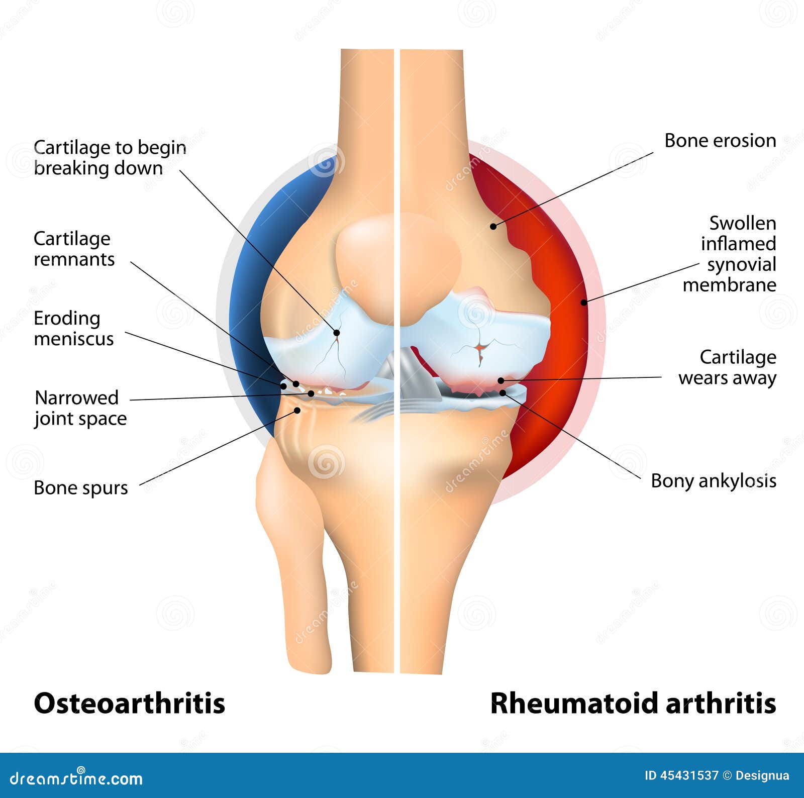 comparison of osteoarthritis and rheumatoid arthritis