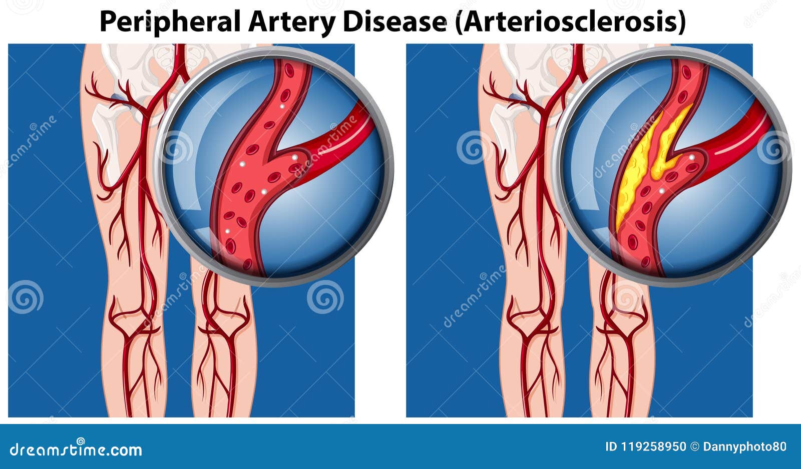 A Comparison of Peripheral Artery Disease Stock Vector Illustration