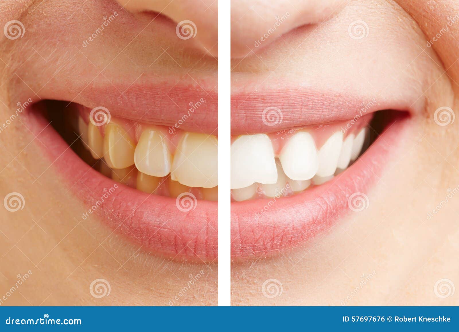 Before And After Comparison Of Teeth Whitening Stock Photo Image