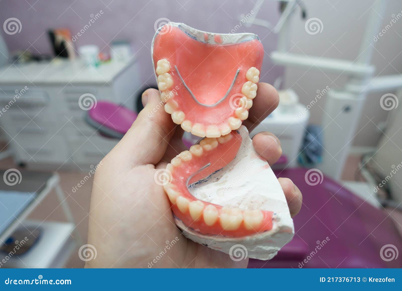 Complete Removable Dental Prostheses on Gypsum Models Stock Image