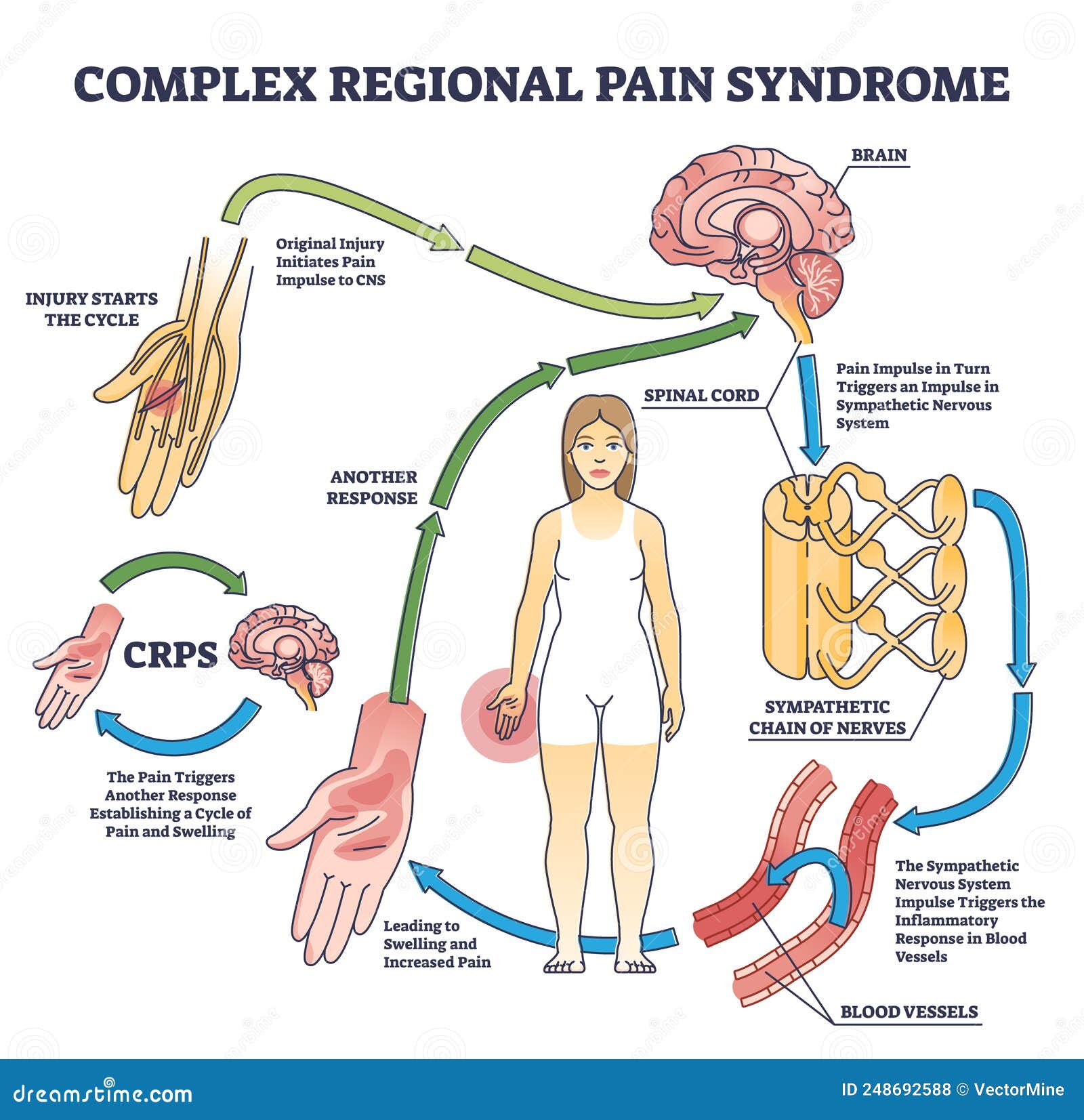 complex regional pain syndrome or crps as painful condition outline diagram