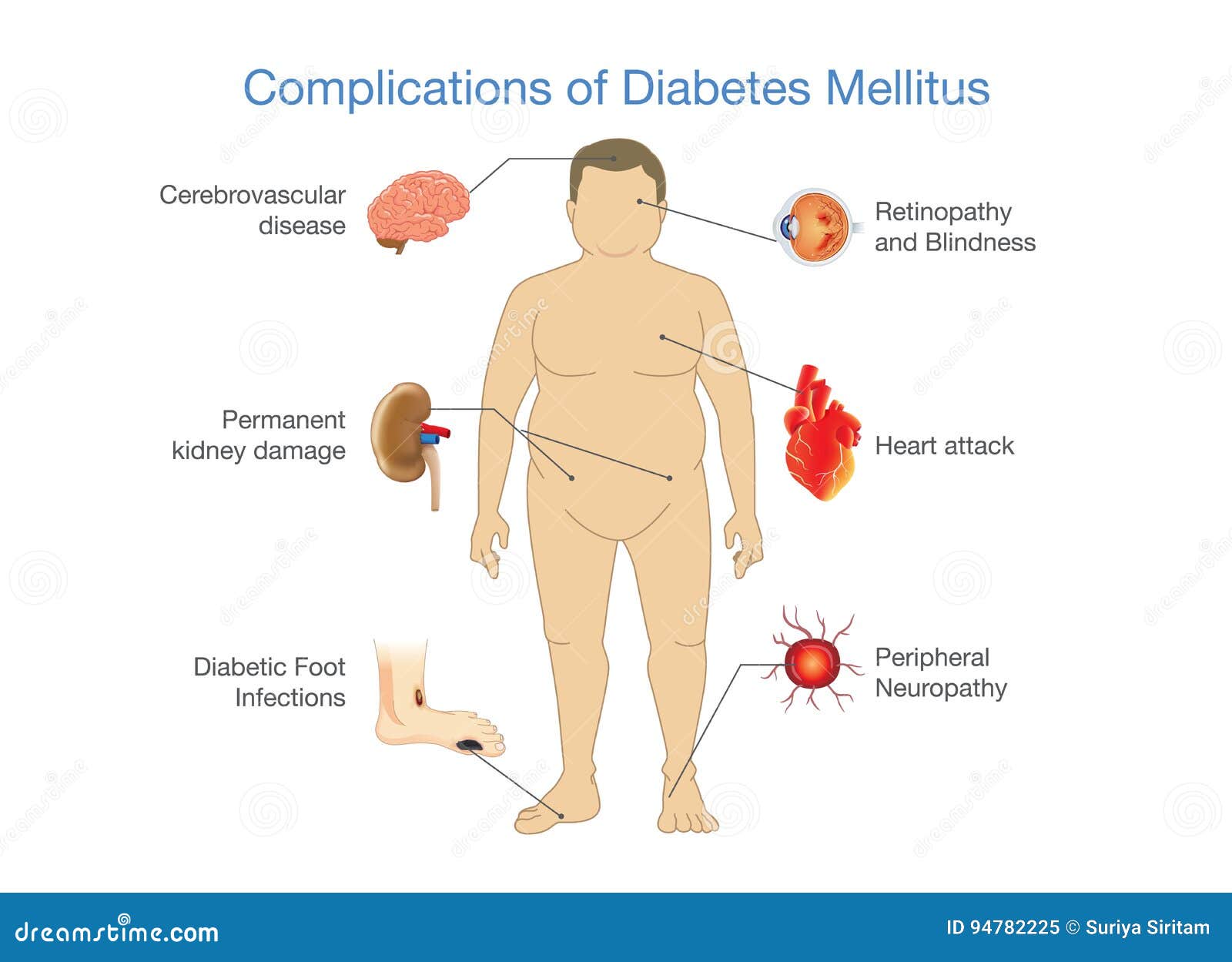 coms diabetes mellitus)