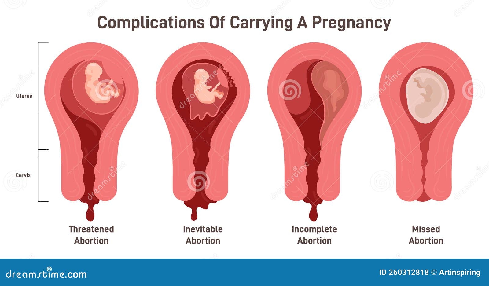 Complications de grossesse