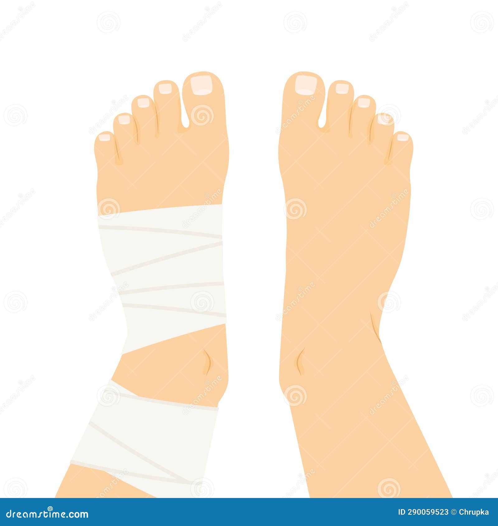 Compression Bandage Wrapped Around the Twisted Ankle Stock Illustration