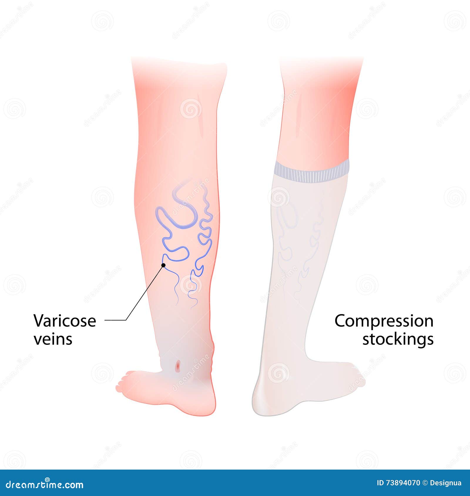 Compression stockings for varicose veins