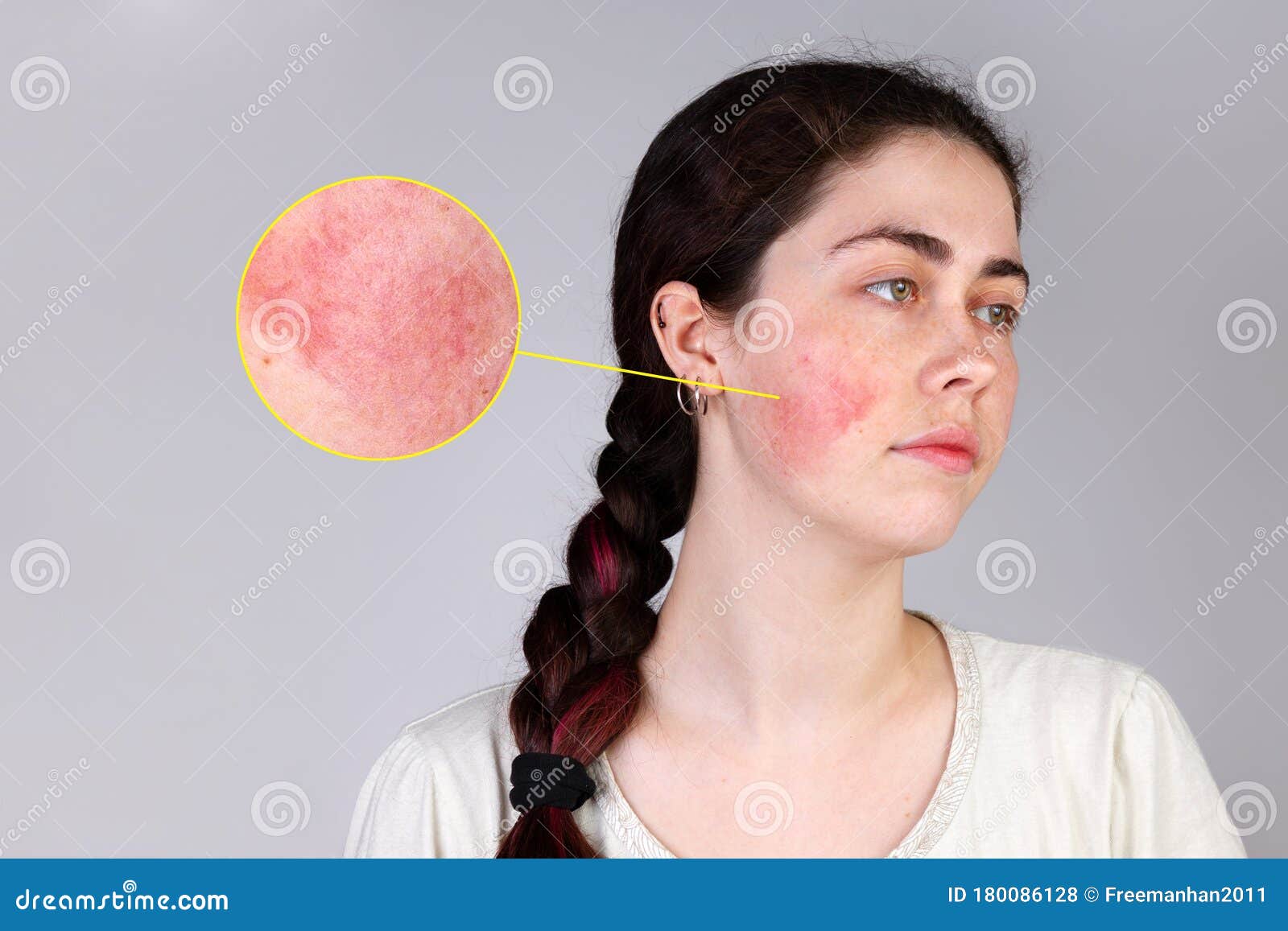the concept of rosacea. a young caucasian woman shows off a red cheek from rosacea. copy space. the enlarged circle shows the