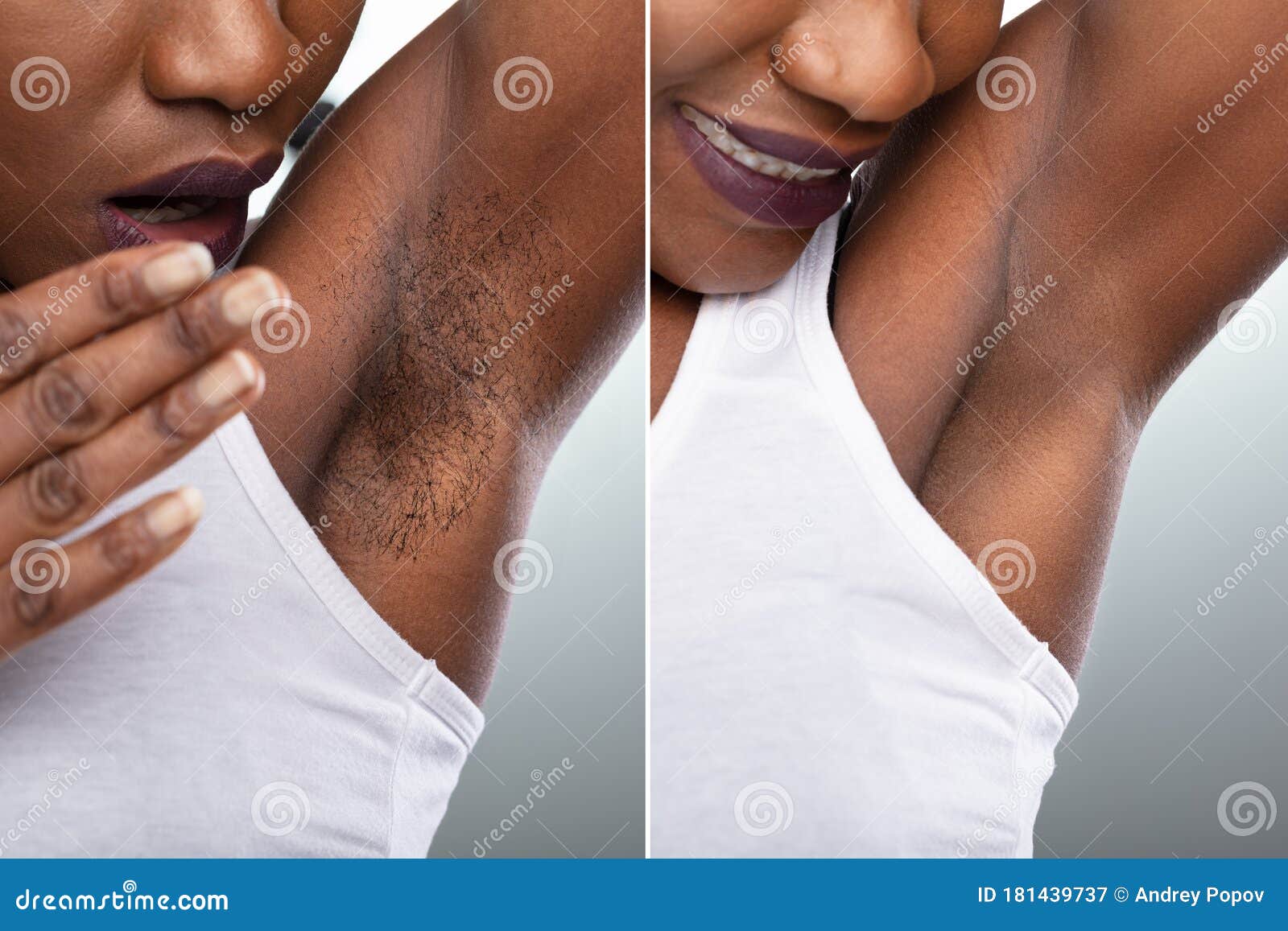 before and after concept of underarm hair removal