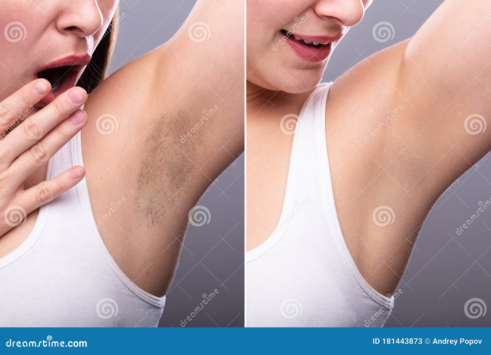before and after concept of underarm hair removal