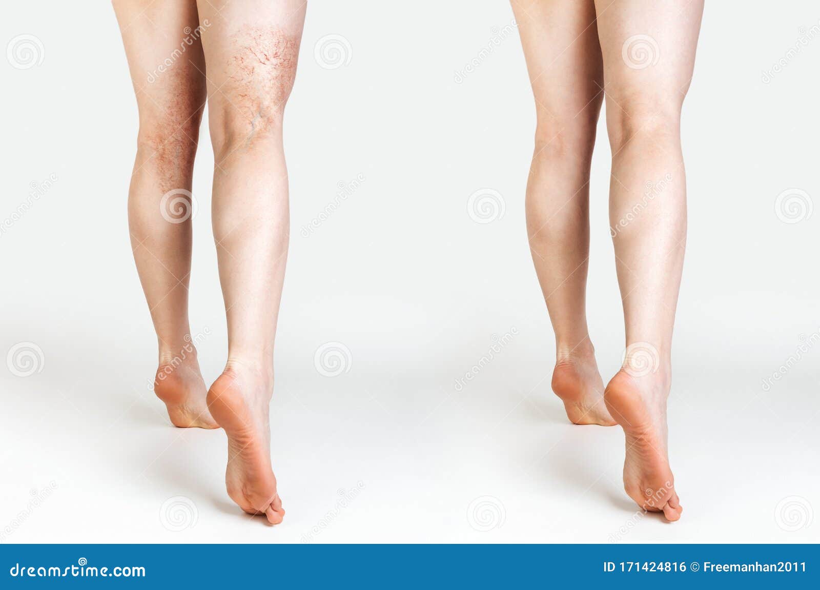 the concept of varicose veins and cosmetic treatment. a caucasian woman massages her legs with and without vascular stars.rear