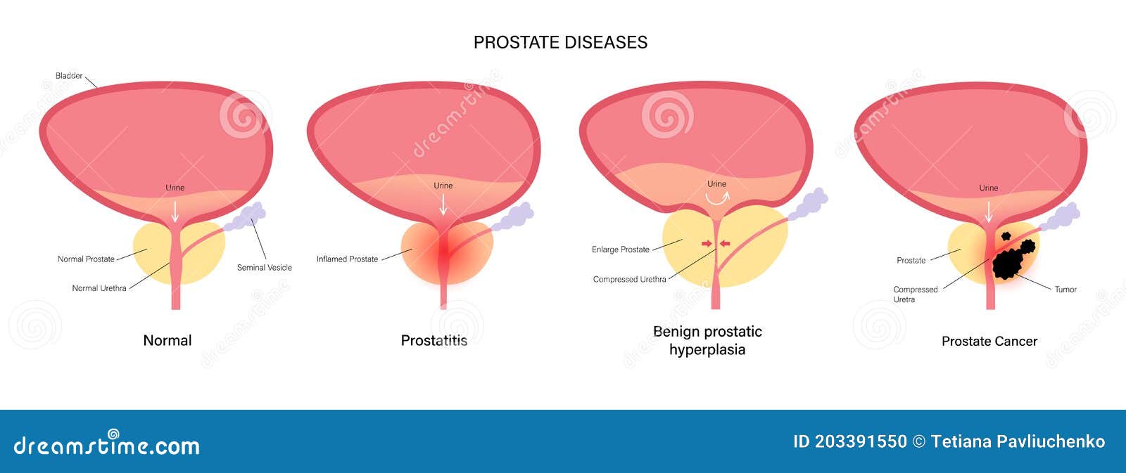 Citomedina pentru adenomul de prostată - Cancer de tiroides mas frecuente