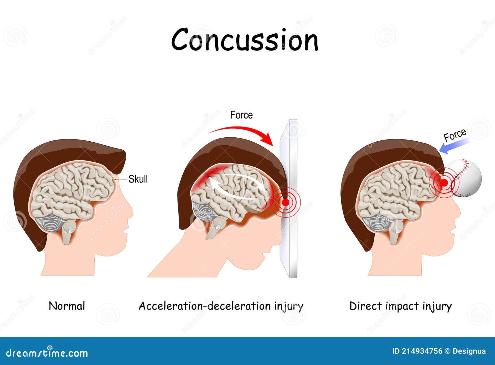 concussion in sport. mild traumatic brain injury