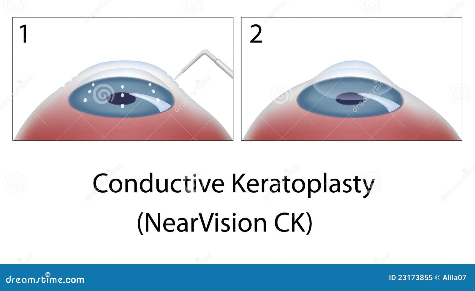 Keratoplastia conductivă: o procedură de a muri?