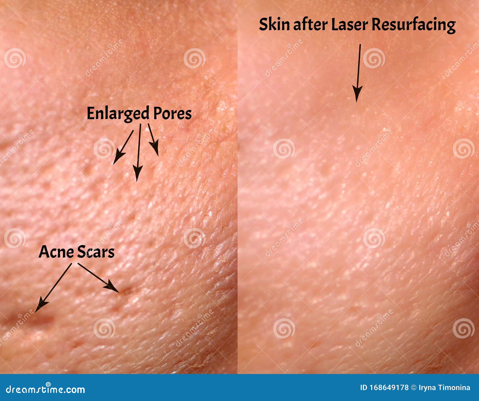 Laser Pori Dilatati Prima E Dopo Markierung Dessert Mappe laser acne prima e dopo Sonnenlicht Diktieren