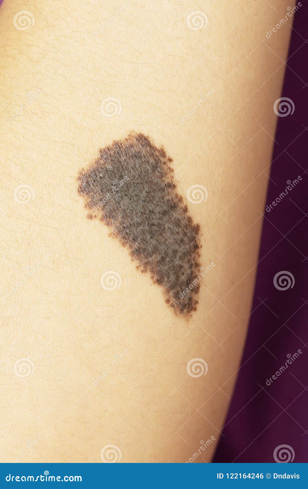 congenital melanocytic naevi birthmark on a woman`s arm