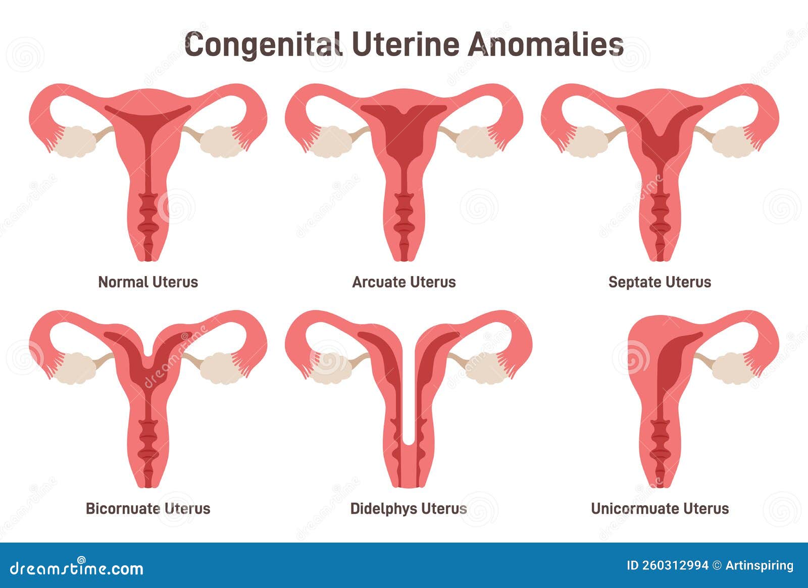 Congenital Uterine Anomalies Set. Female Reproductive System Medical