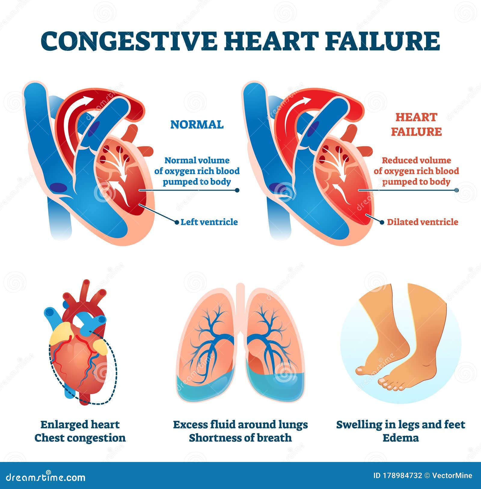 how long does stage 2 copd last