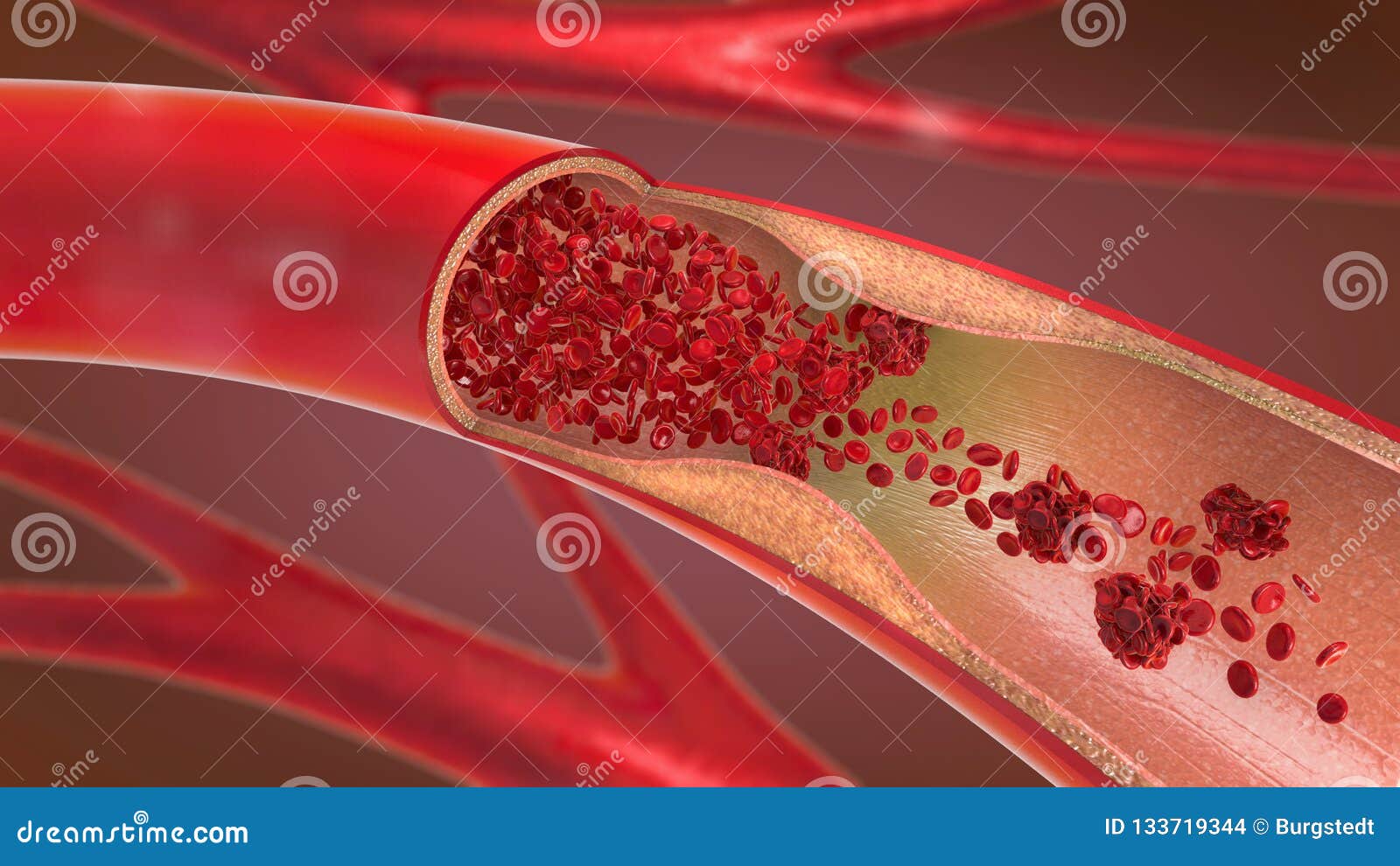 constricted and narrowed artery and the blood cannot flow properly called arteriosclerosis