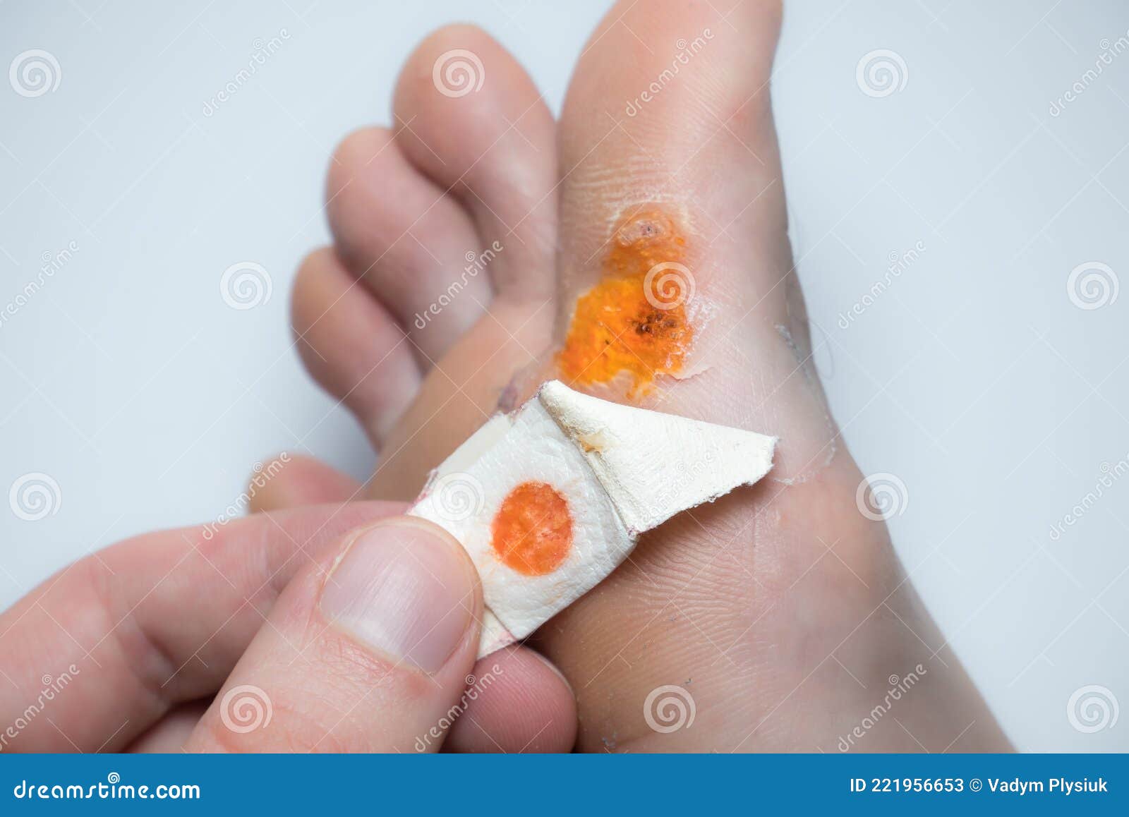 salicylic acid plantar warts