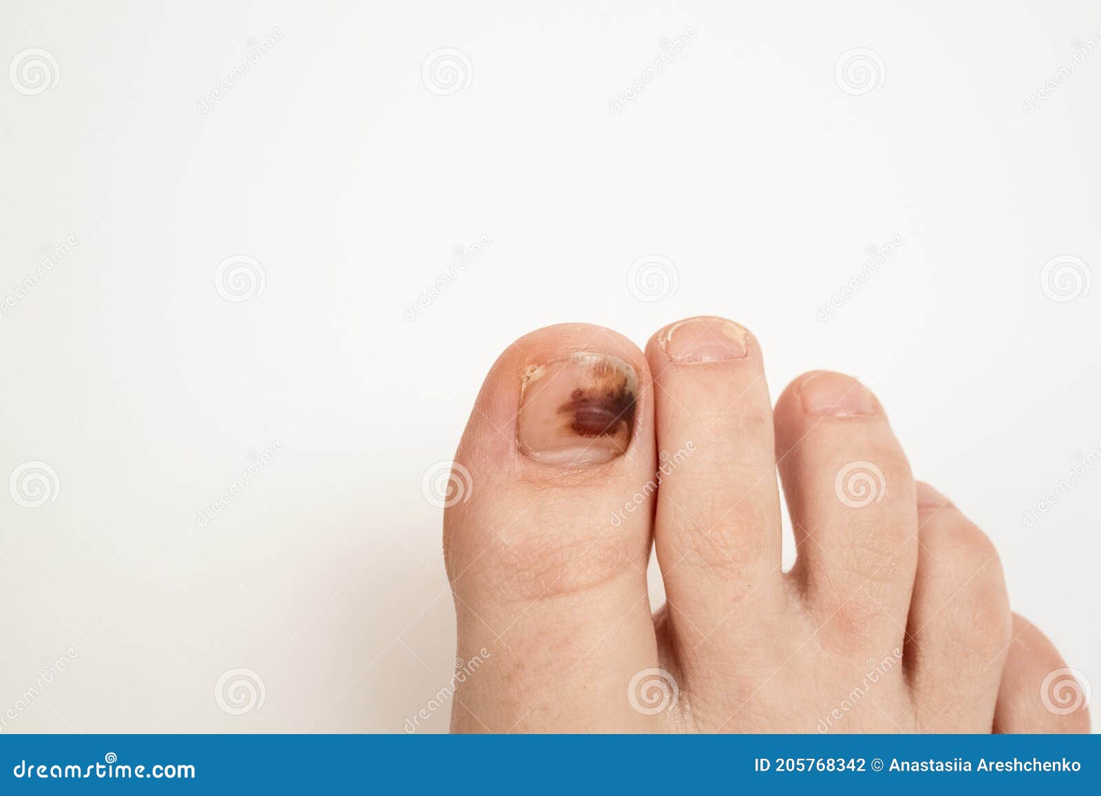 Contusion Sous L'ongle Du Gros Orteil Photo stock - Image du clous ...