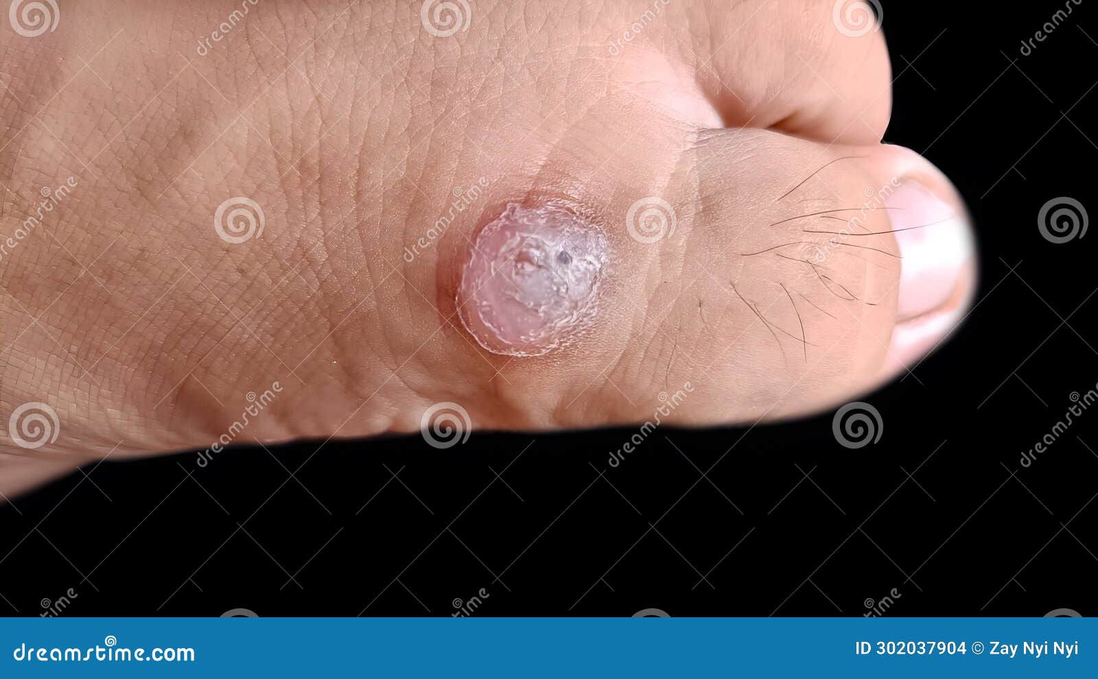 Corn or Callus at the Base of Big Toe Stock Photo Image of diabetic
