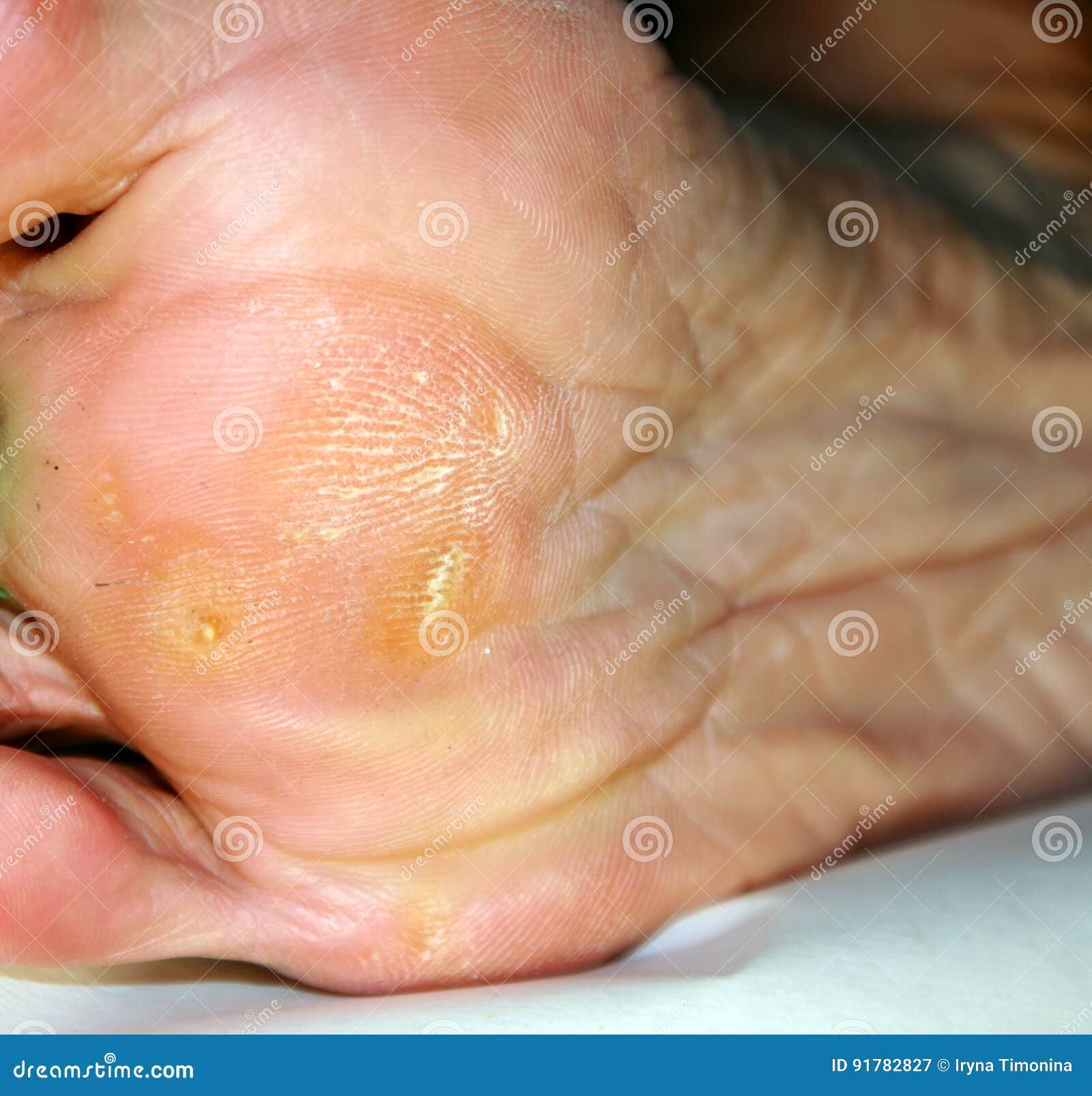 Corn on the Foot. Foot Sole with Corn Stock Image Image of french