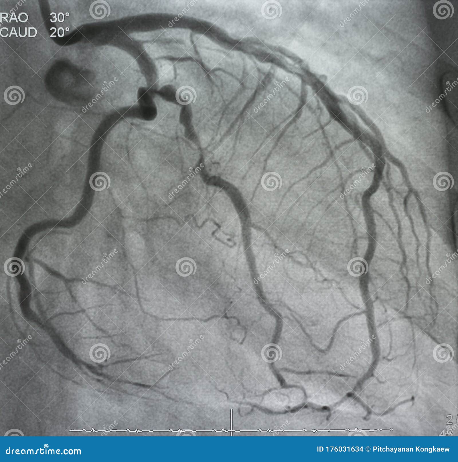 coronary angiography. x-ray image.