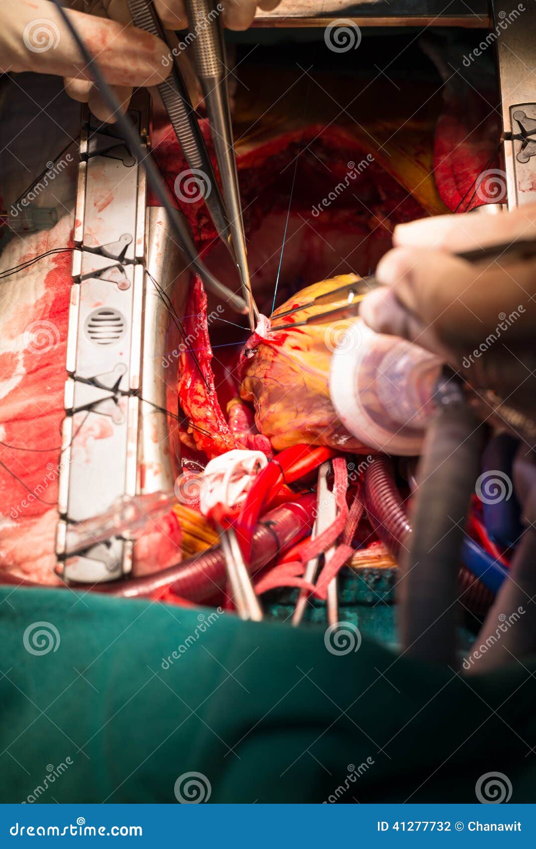 coronary artery bypass grafting obtuse marginal artery