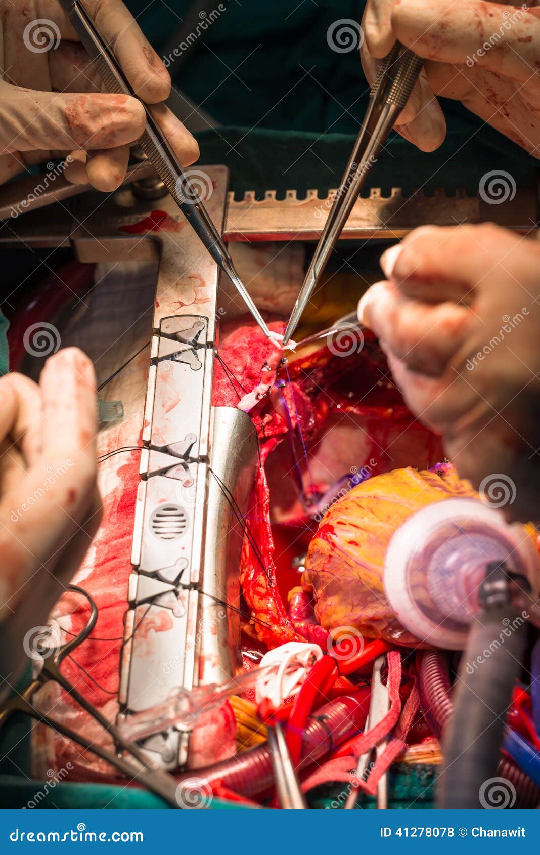 coronary artery bypass grafting obtuse marginal artery