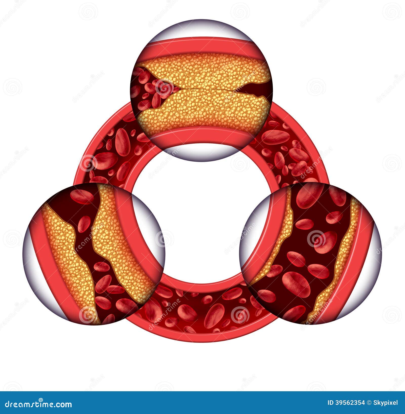 coronary artery disease