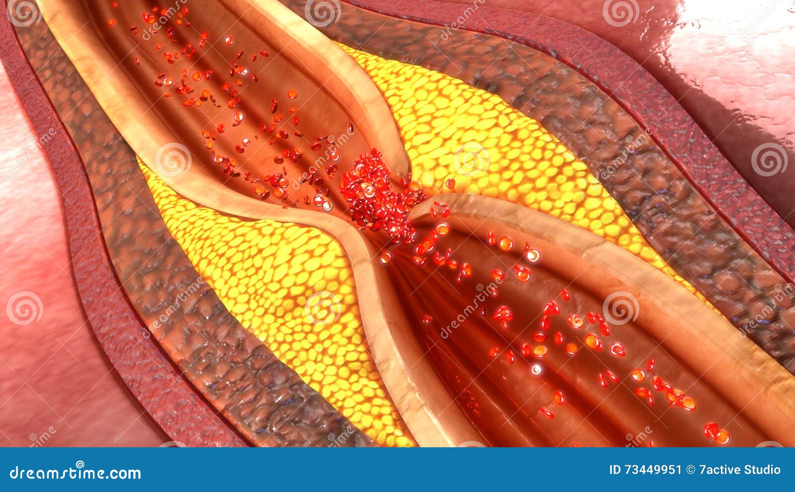 coronary artery plaque