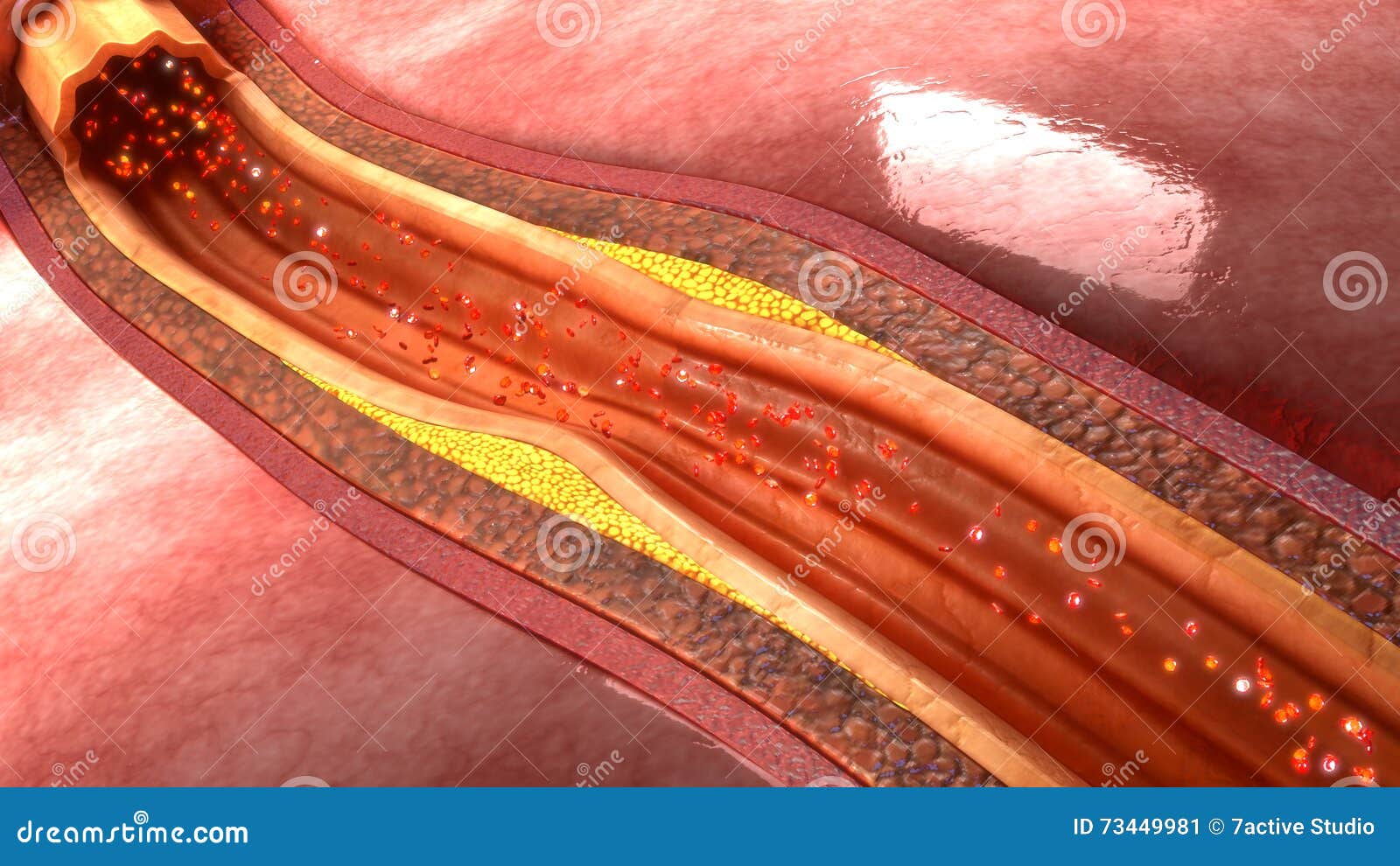 coronary artery plaque
